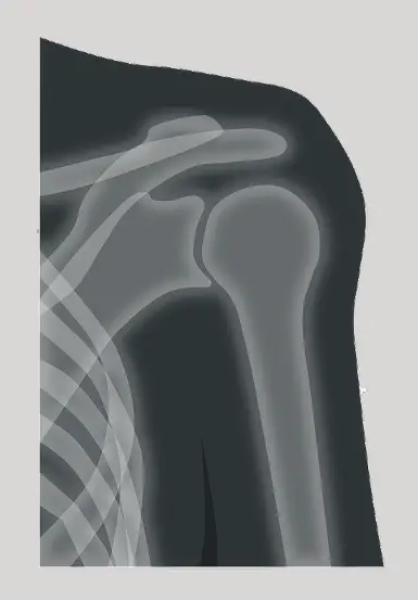 Bone health